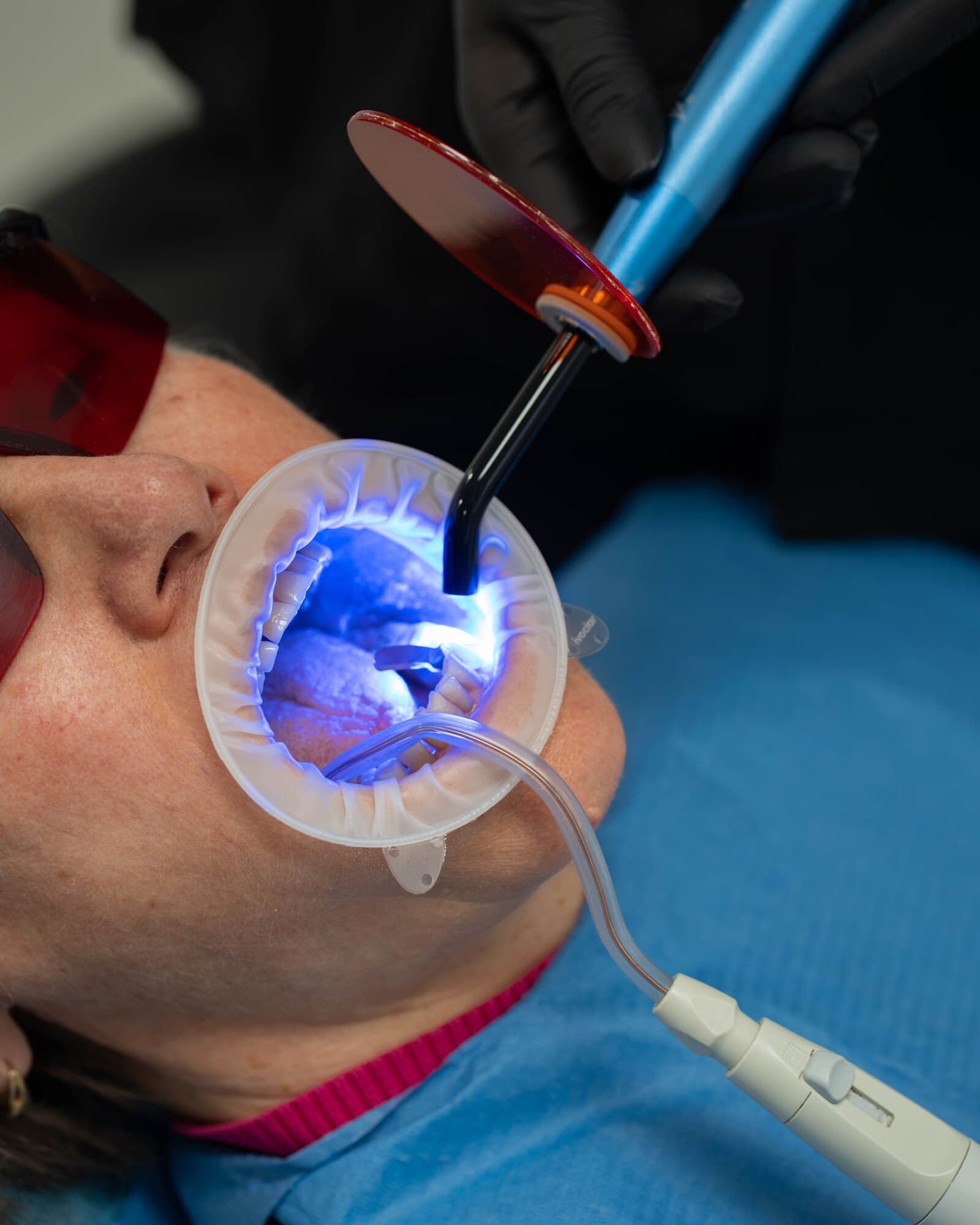 Obturație compozit — cavitate mare